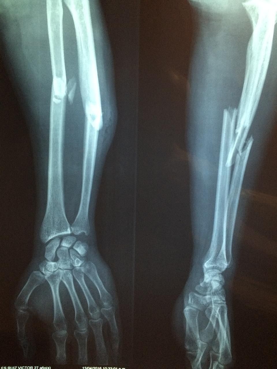 fracture bone, xray, skeleton-2333164.jpg